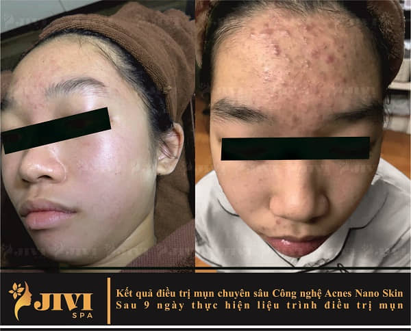 Jivi Spa - Spa trị mụn Gò Vấp
