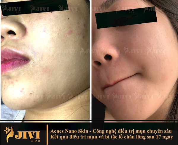 Liệu trình điều trị mụn và bít tắc lỗ chân lông sau 17 ngày