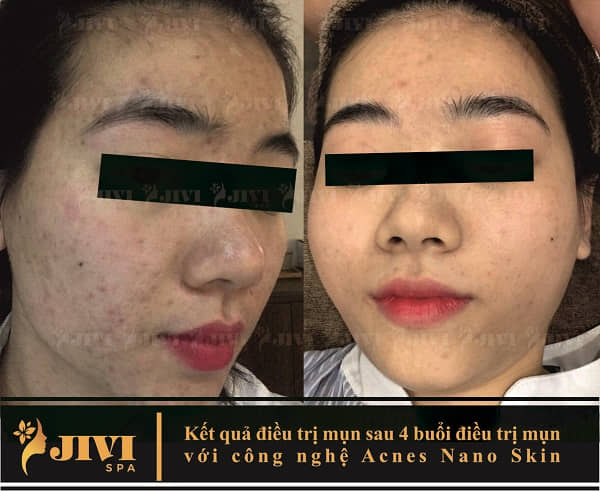 Kết quả điều trị tại sau liệu trình trị mụn 4 ngày