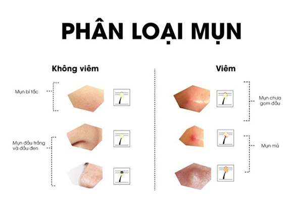 Phân biệt mụn viêm và mụn không viêm