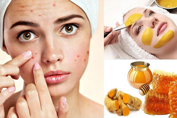 Trị mụn với mật ong và nghệ tươi thiên nhiên