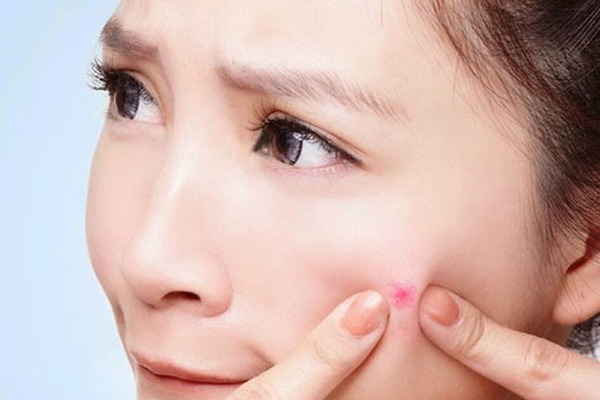 Hạn chế nặn mụn tránh thâm sạm da