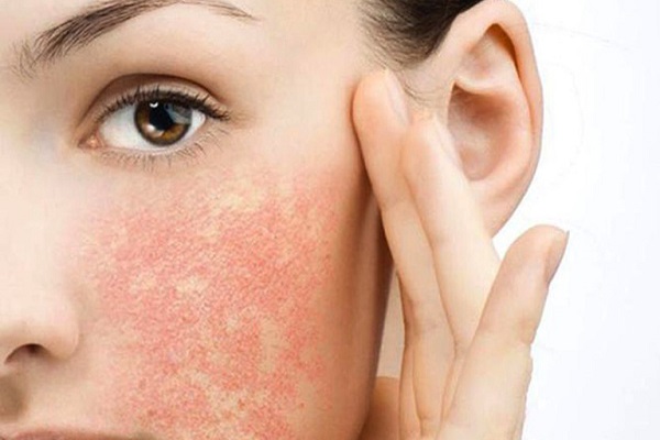 Da dễ bị viêm nhiễm