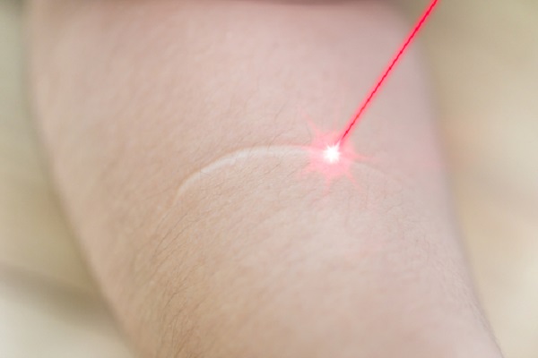 Điều trị sẹo lồi bằng Laser