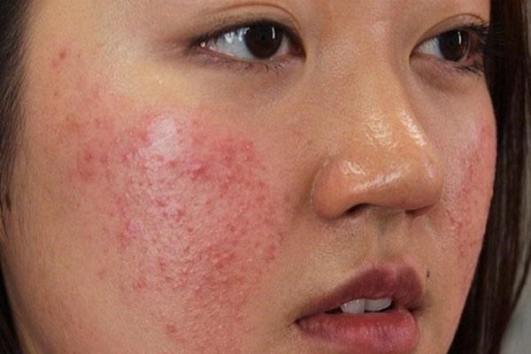 Mụn dị ứng nổi khắp trên da