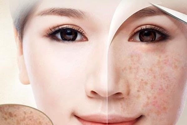 Điều trị nám và tàn nhang