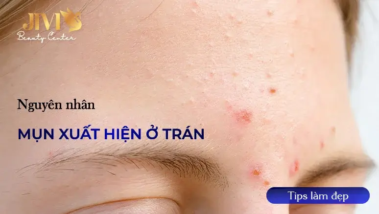 mụn xuất hiện ở vùng trán