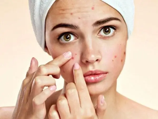 kem trị mụn hiệu quả với da mụn