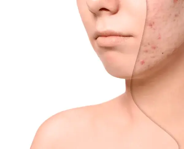 sẹo rỗ lâu năm khiến nhiều người lo lắng