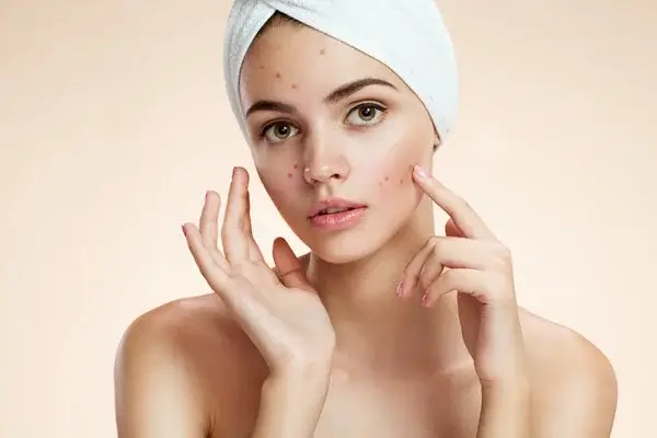 lưu ý khi trị mụn cho mẹ bầu