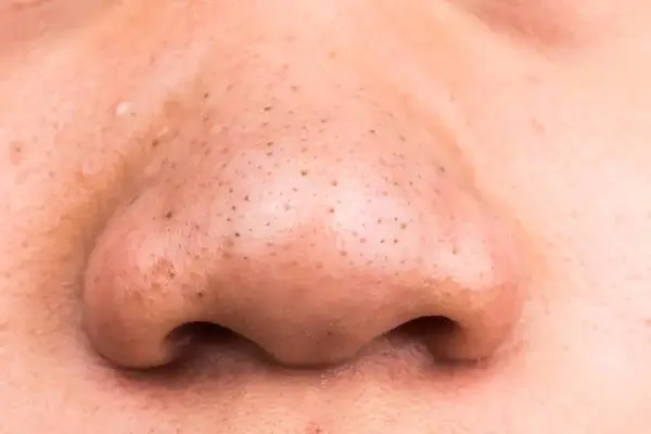 nguyên nhân xuất hiện mụn đầu đen trên da dầu