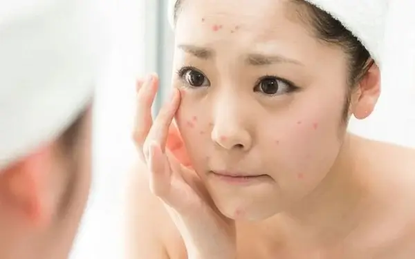 nhiều nguyên nhân nổi mụn do đeo khẩu trang