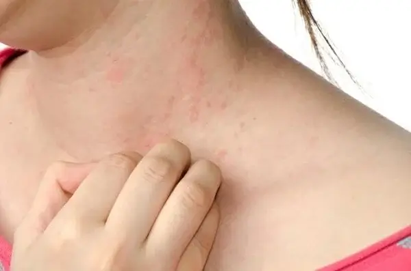 Da nhạy cảm dễ bị ngứa