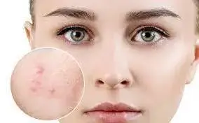 sử dụng retinol có thể giúp bạn điều trị mụn trứng cá