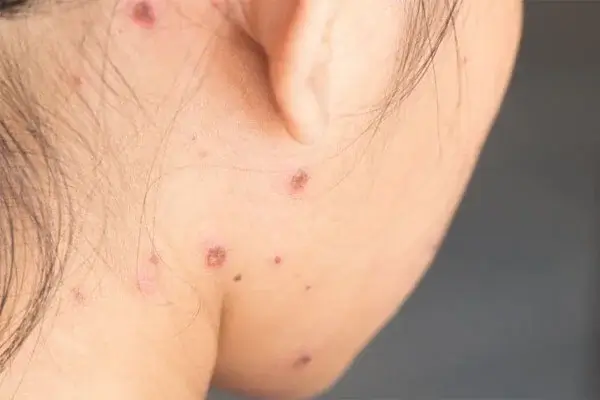 Thủy đậu không chỉ gây ra mụn nước ở tay mà còn các vùng khác nhau trên cơ thể