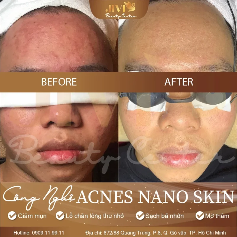 Kết quả trước sau liệu trình Acnes Nano Skin