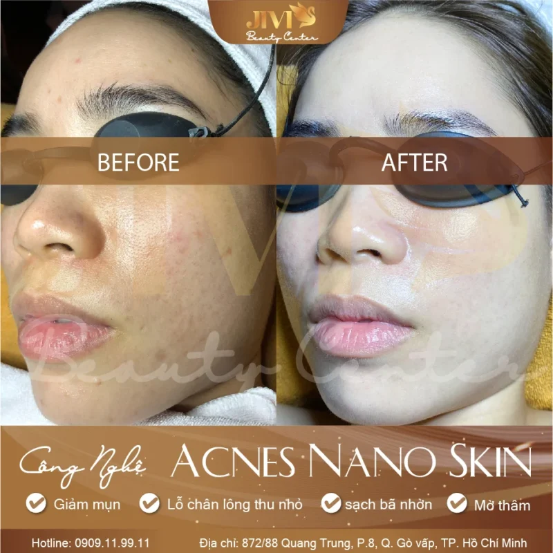 Kết quả trước sau liệu trình Acnes Nano Skin