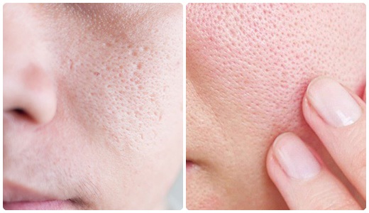 Hậu quả của lỗ chân lông to đến làn da của bạn