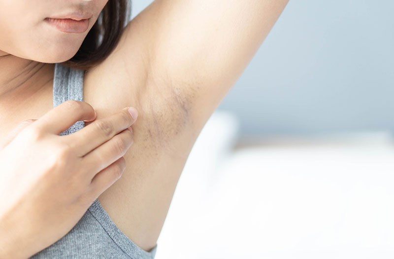 Nguyên nhân thâm nách và làm sao để giảm thâm nách