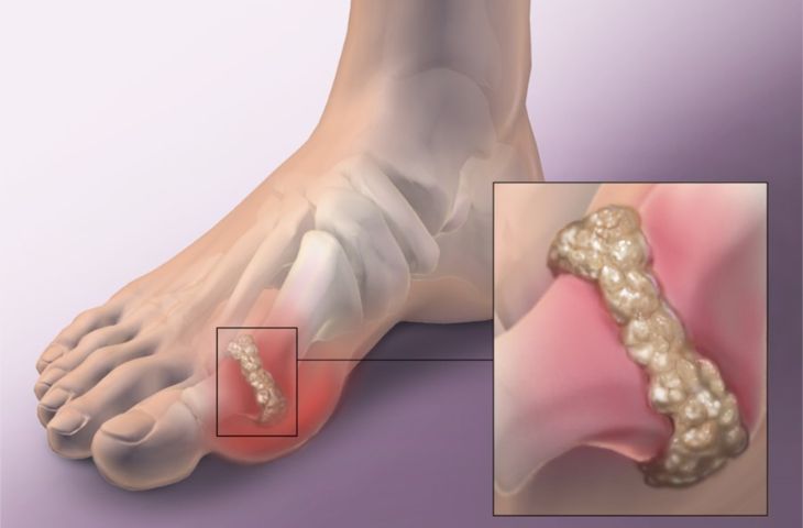 Bệnh gút là gì? Ảnh hưởng thế nào đến sức khỏe