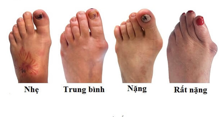 Các giai đoạn và biểu hiện của bệnh Gout
