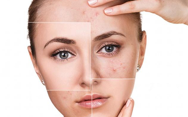 Điều trị sẹo thâm giúp da mịn màng và tự tin