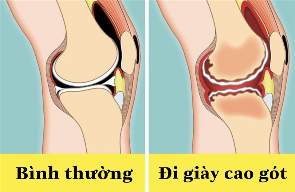 Thói quen đi giày cao gót liên tục làm tăng nguy cơ viêm khớp chân