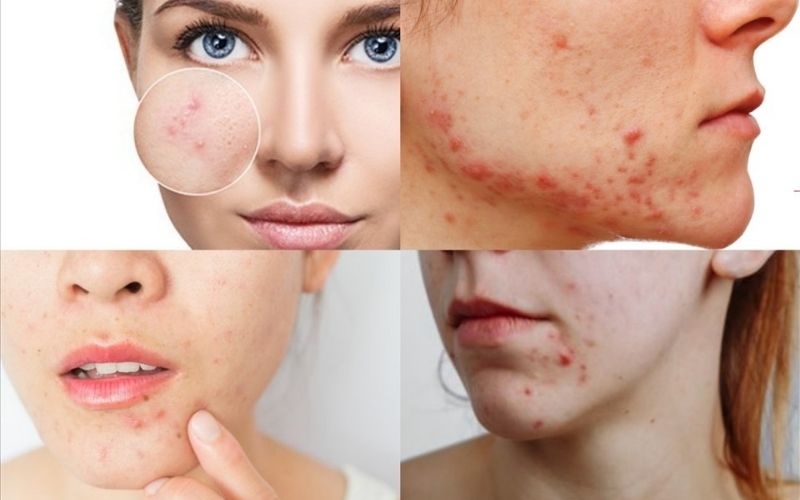Nguyên nhân gây mụn và cách nhận diện các loại mụn phổ biến