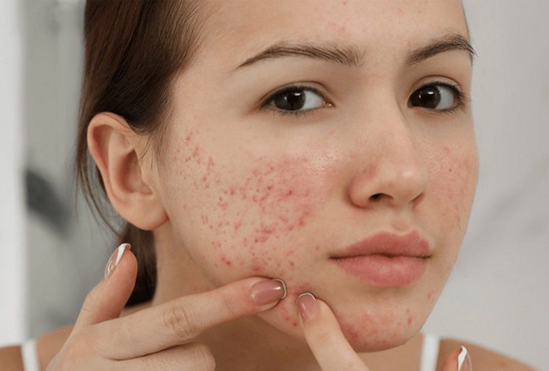 Chăm sóc da sau khi nặn mụn giúp ngăn ngừa mụn tái phát và làm dịu da