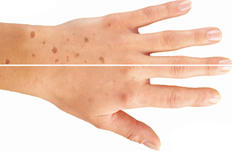 Da tay bị xỉn màu do tác động của ánh nắng mặt trời và tia UV