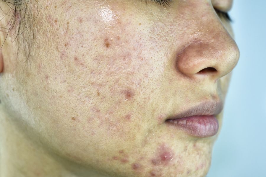 Da bị mụn lâu năm với các nốt sưng viêm, khó điều trị