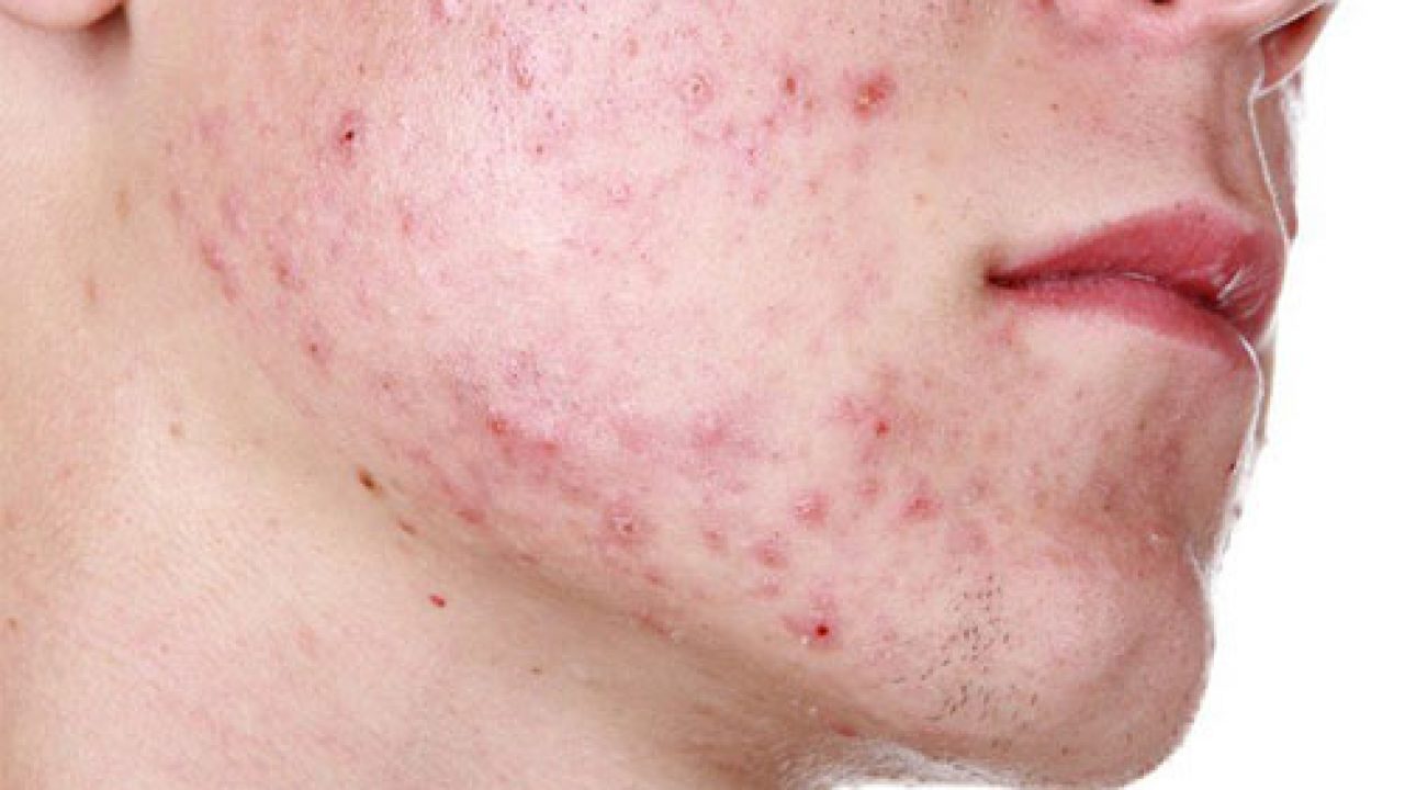 Mụn tái phát nhiều lần dù đã điều trị
