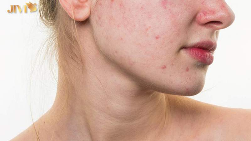 Nổi mụn nhiều do thói quen rửa mặt không đúng