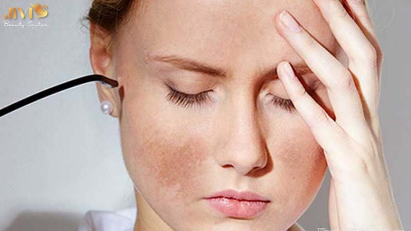 Lưu ý khi chữa nám để đạt hiệu quả cao