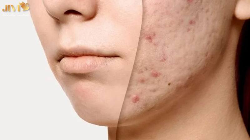 Da thường xuyên bít tắc, sần sùi do chăm sóc sai cách