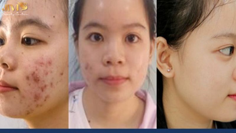 Mụn viêm sâu cần liệu trình chuyên sâu