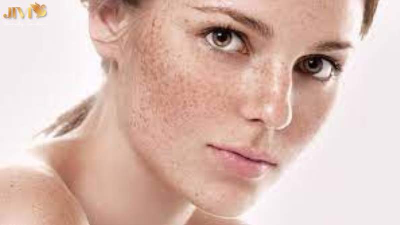 Khi nào bạn nên cân nhắc đi spa trị nám?