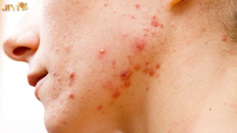 Trường hợp nào nên đi spa trị mụn?