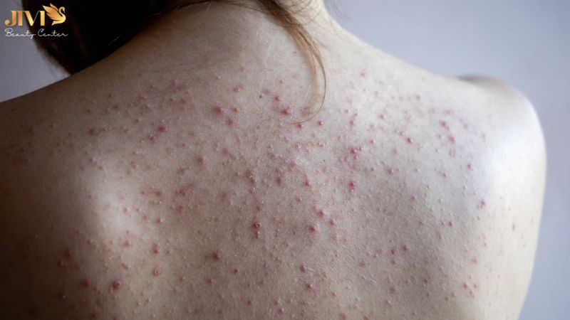 Dấu hiệu cho thấy bạn đang bị mụn nội tiết kéo dài
