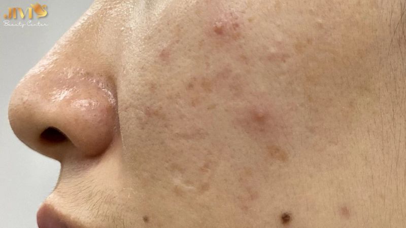 Những sai lầm thường gặp khi trị mụn nội tiết