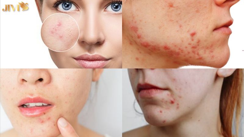 Vì sao cần ổn định nội tiết để trị mụn?