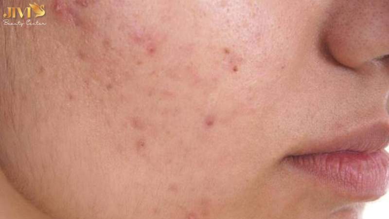 Cách phân biệt mụn nội tiết và mụn thường