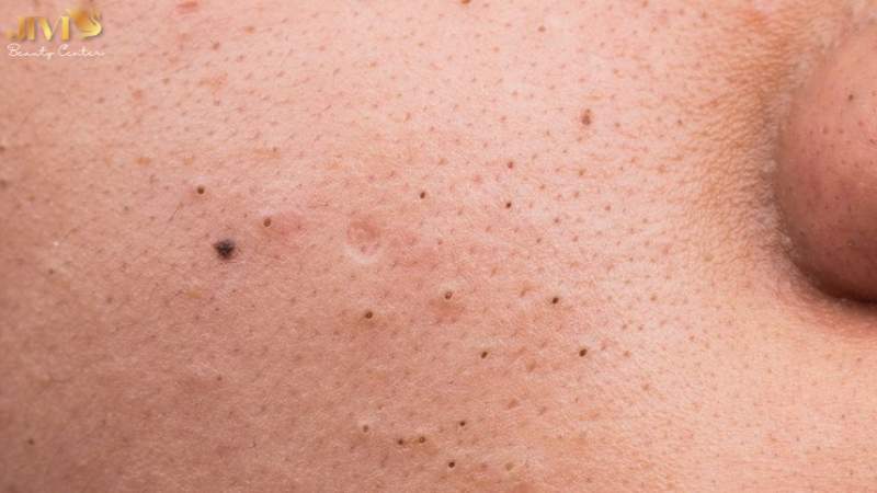 Hướng dẫn xử lý từng loại mụn đúng cách