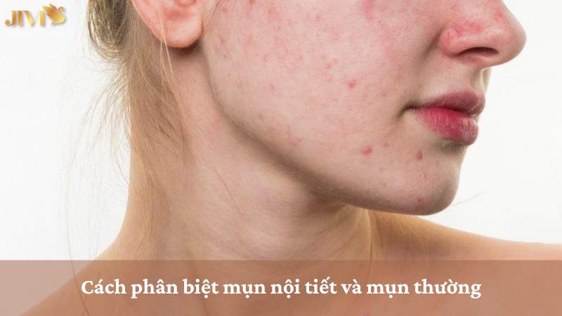 Cách phân biệt mụn nội tiết và mụn thường