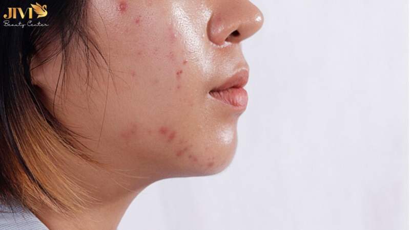Skincare đúng cách cho da mụn nội tiết