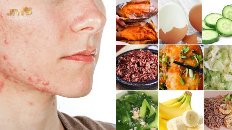 Vì sao chế độ ăn đóng vai trò quan trọng trong trị mụn nội tiết?