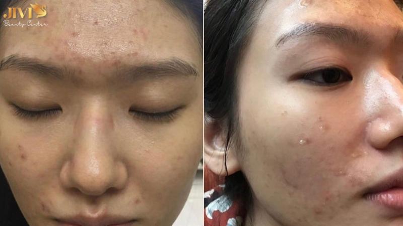 Vì sao rối loạn hormone gây mụn trứng cá?