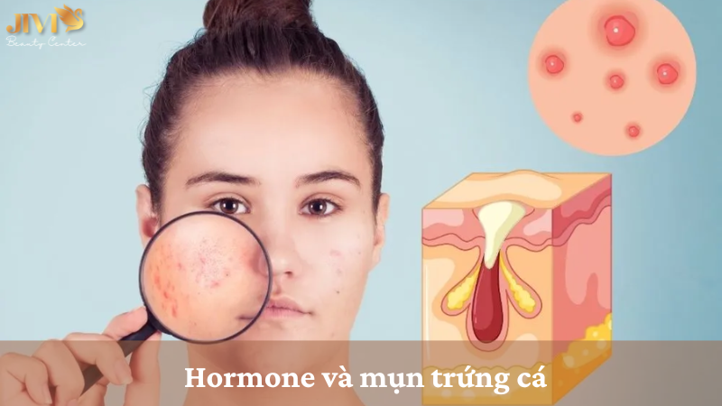 Hormone và mụn trứng cá