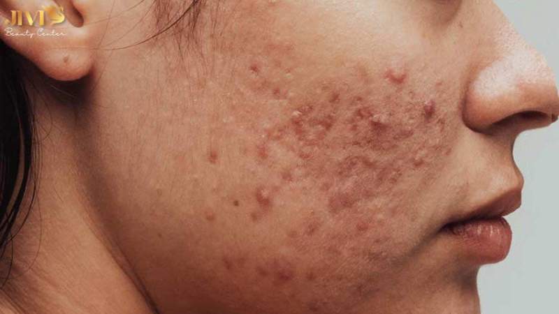 Điều trị mụn nội tiết tại Jivi Spa