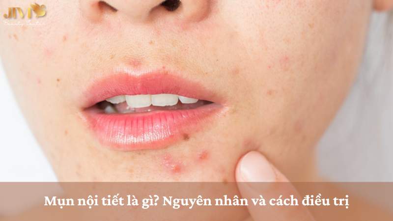 mụn nội tiết là gì